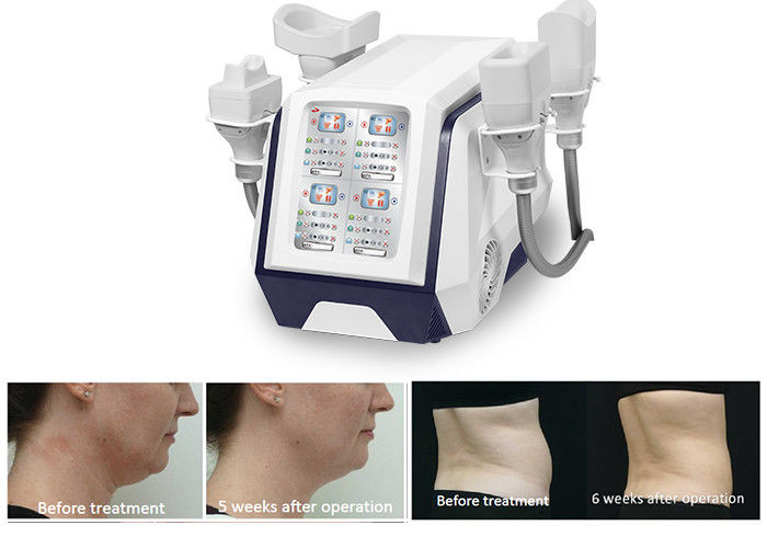 Corps portatif de 360 Cryolipolysis amincissant la machine 1000W pour la grosse perte de poids brûlante